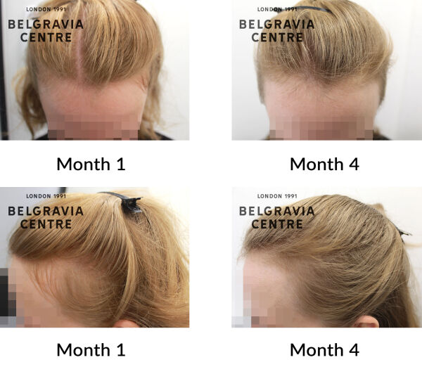 female pattern hair loss the belgravia centre 449555