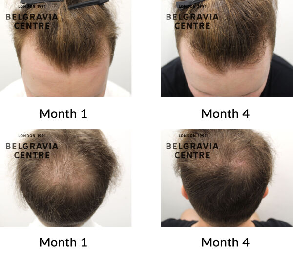 male pattern hair loss the belgravia centre 441398