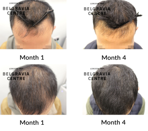 male pattern hair loss the belgravia centre 466090