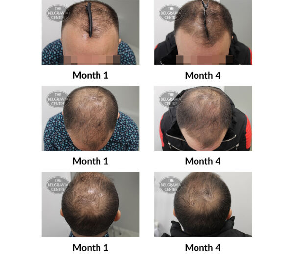 male pattern hair loss the belgravia centre 391781 23 04 2020