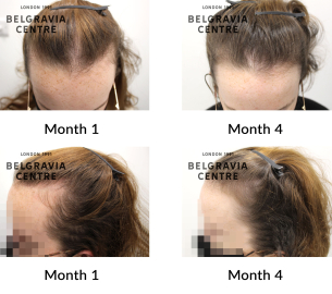 female pattern hair loss and telogen effluvium the belgravia centre 432602