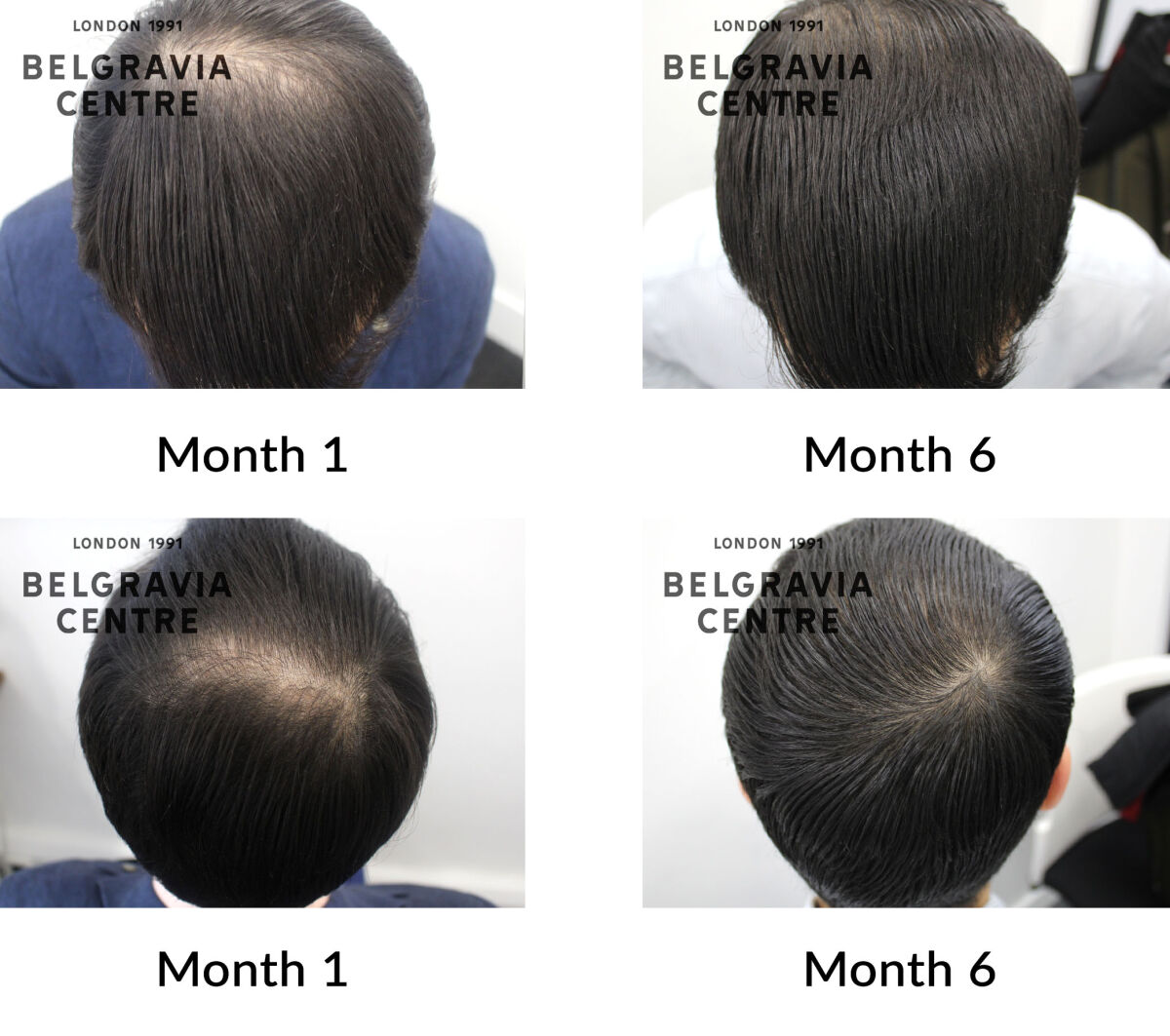 male pattern hair loss the belgravia centre 440156
