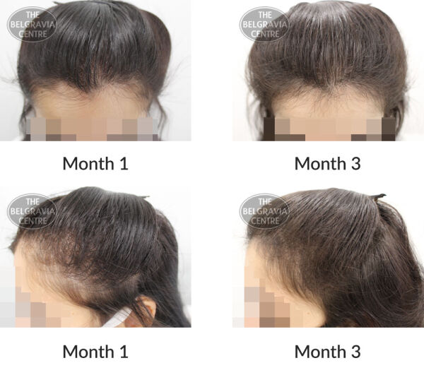 female pattern hair loss the belgravia centre 397077 30 09 2020