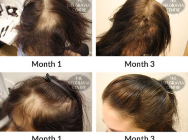 Alopecia Areata Hair Loss Successfully Treated By The Belgravia Centre