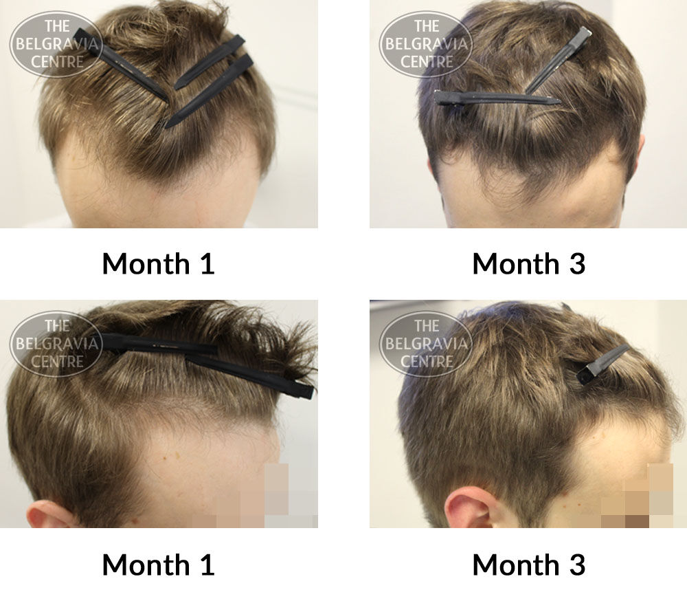 male pattern hair loss the belgravia centre 380140 12 06 2019