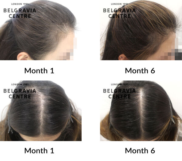 female pattern hair loss the belgravia centre 432898