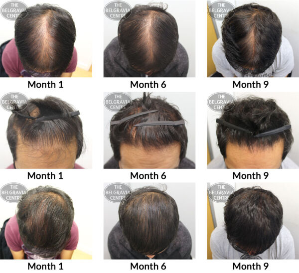 Male Pattern Hair Loss The Belgravia Centre RS 18 05