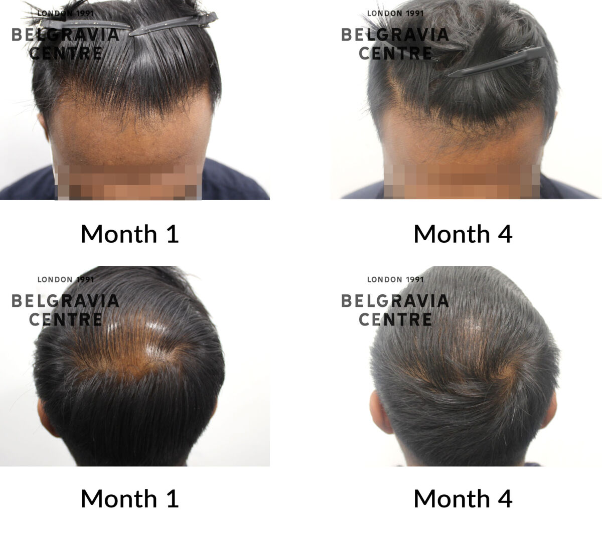 male pattern hair loss the belgravia centre 434814
