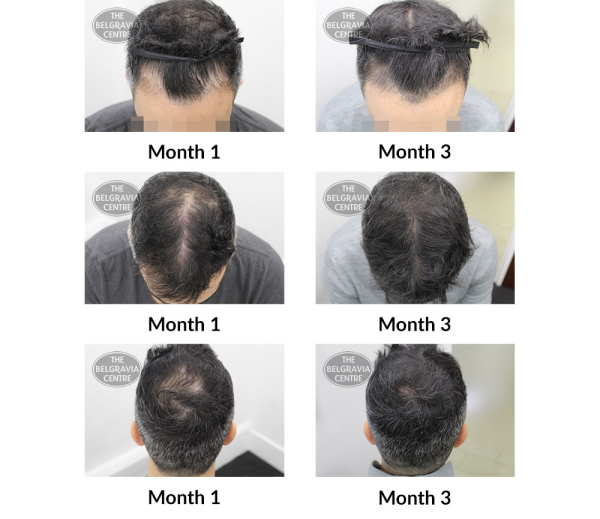 male pattern hair loss the belgravia centre 391080 07 01 2019