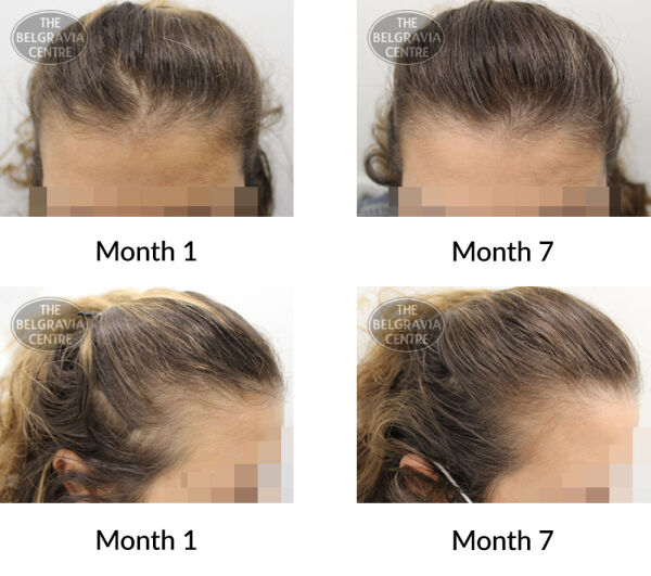 female pattern hair loss the belgravia centre 228639 04 08 2020