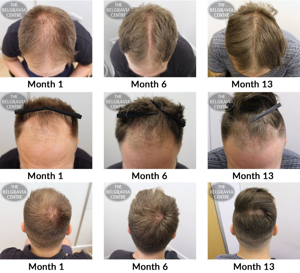 Male Pattern Hair Loss The Belgravia Centre JB 07 09