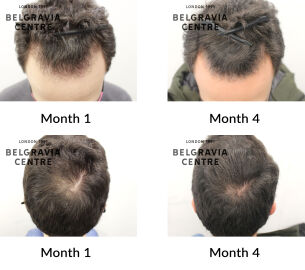 male pattern hair loss the belgravia centre 433690