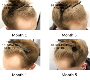 male pattern hair loss the belgravia centre 454082
