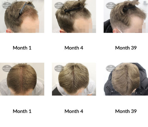 male pattern hair loss the belgravia centre 356157 19 05 2021