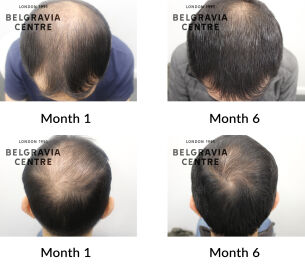 male pattern hair loss the belgravia centre 443751