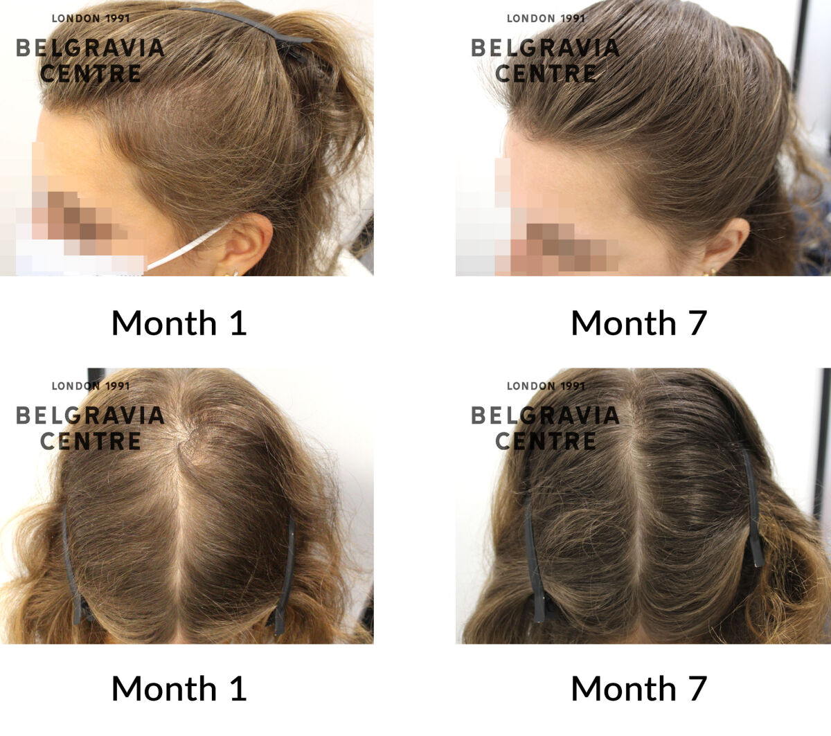 telogen effluvium chronic and female pattern hair loss the belgravia centre 430008