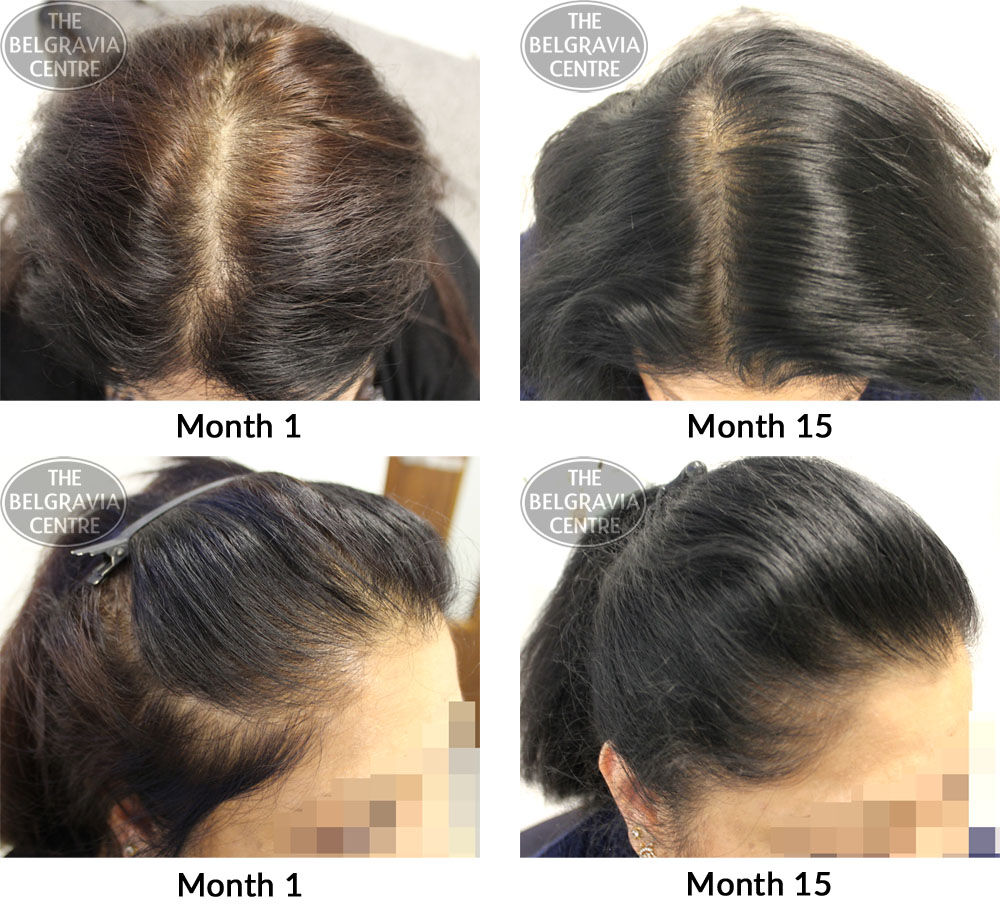 female pattern hair loss the belgravia centre kp 22 11 2017