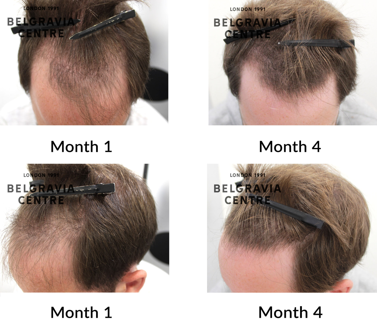 male pattern hair loss the belgravia centre 457021