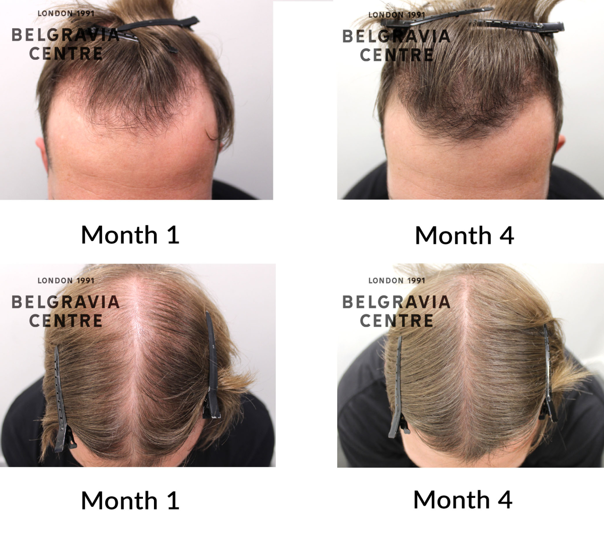 male pattern hair loss the belgravia centre 458807