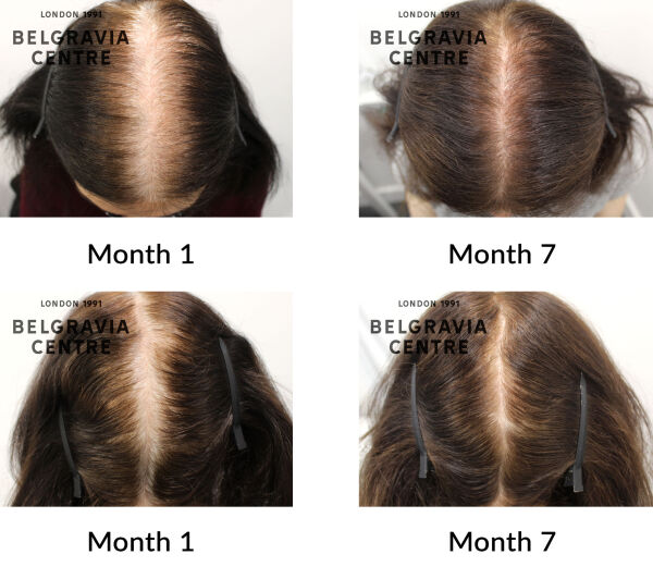 female pattern hair loss the belgravia centre 432430