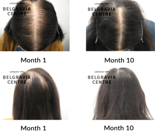 female pattern hair loss the belgravia centre 453426