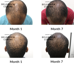 male pattern hair loss the belgravia centre 451086