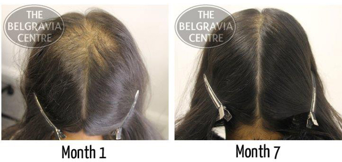 1 Female Hair Loss Patient Belgravia Centre Hair Loss Clinic London