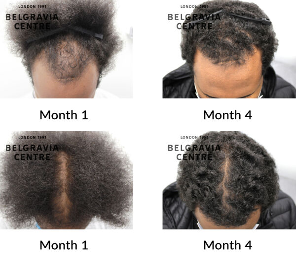 male pattern hair loss the belgravia centre 430022