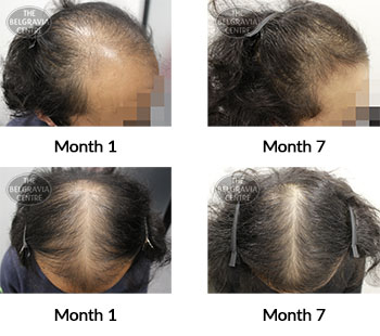 alert male pattern hair loss the belgravia centre 408886 26 04 2021