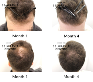 male pattern hair loss the belgravia centre 469363