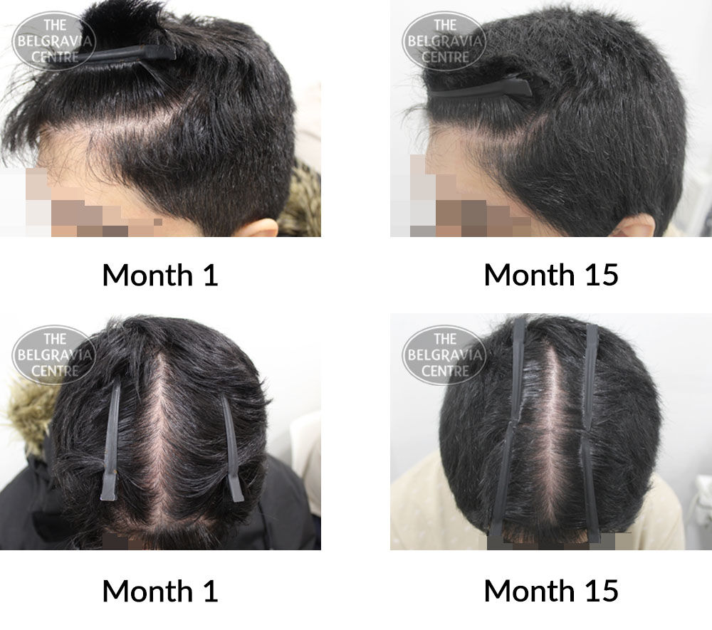 male pattern hair loss the belgravia centre 388725 17 05 2021