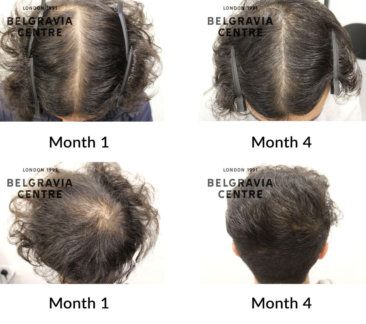 male pattern hair loss the belgravia centre 450193