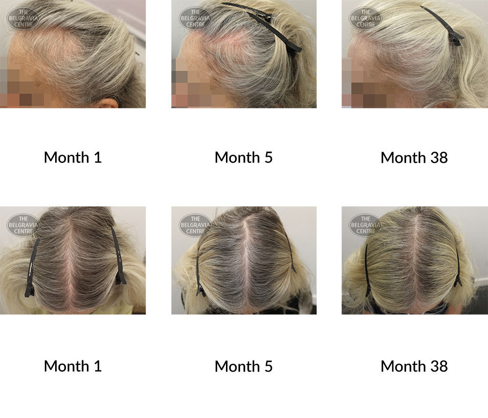 female pattern hair loss the belgravia centre 339959 21 09 2020