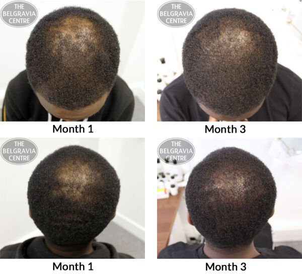 Male Pattern Hair Loss The Belgravia Centre EDS 10 06