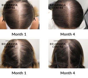 female pattern hair loss and telogen effluvium chronic the belgravia centre