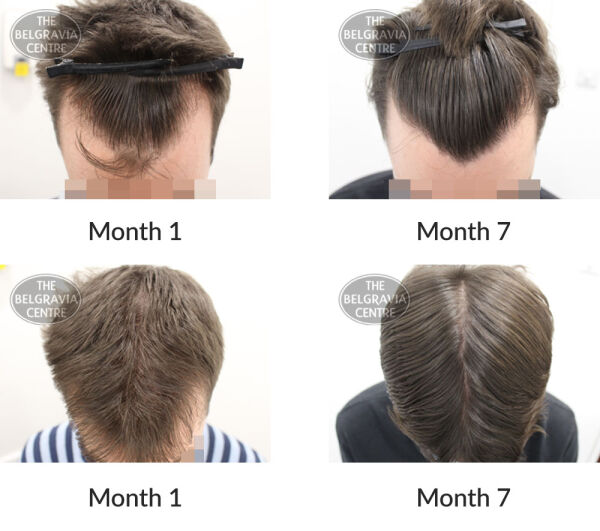 male pattern hair loss the belgravia centre 397666 06 10 2020