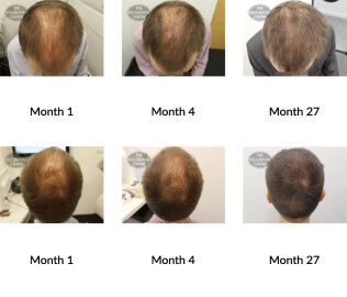 male pattern hair loss the belgravia centre 315172 29 07 2021