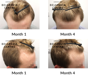 male pattern hair loss the belgravia centre 435402