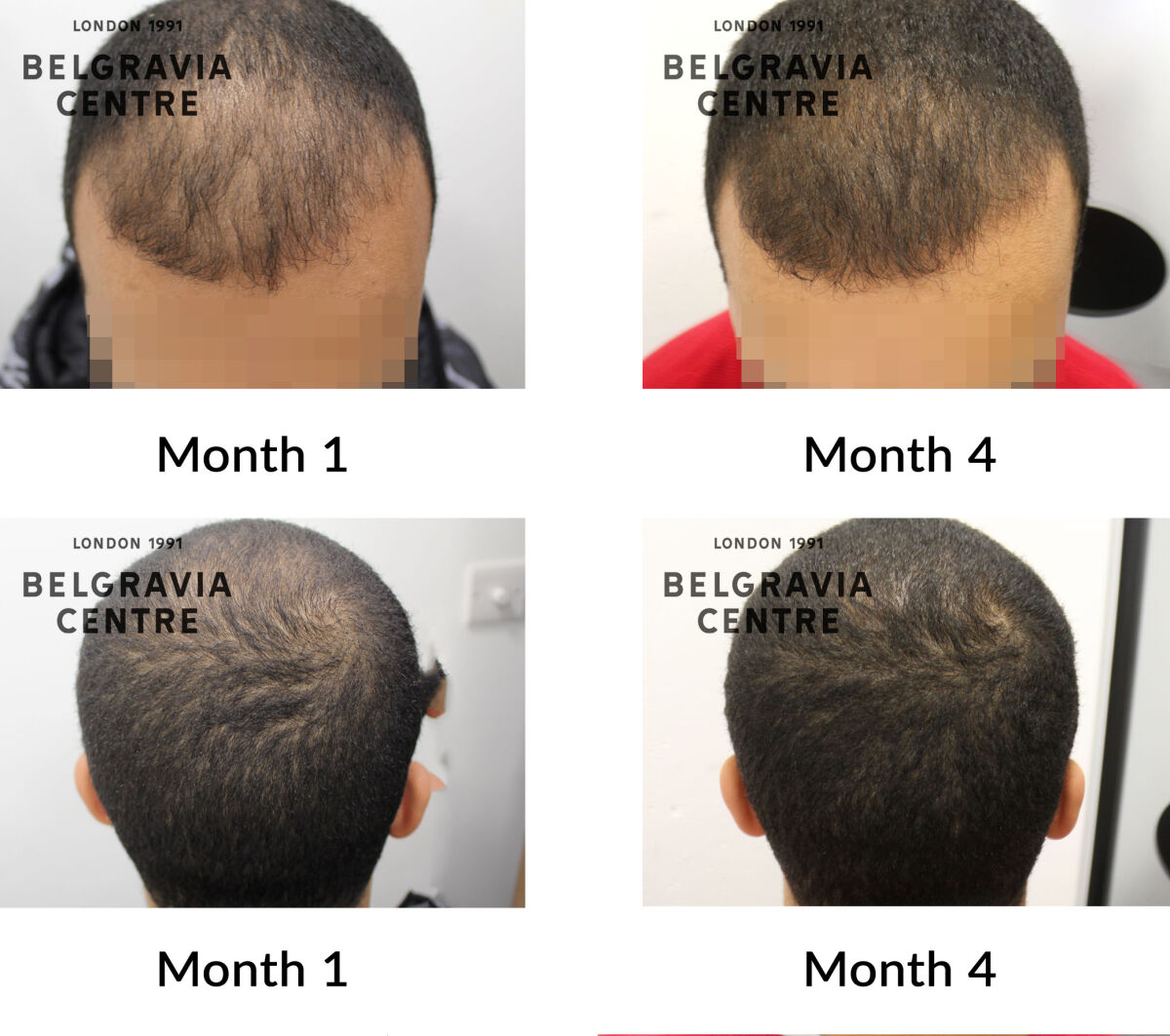 male pattern hair loss the belgravia centre 438743