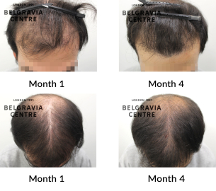 male pattern hair loss the belgravia centre 403818