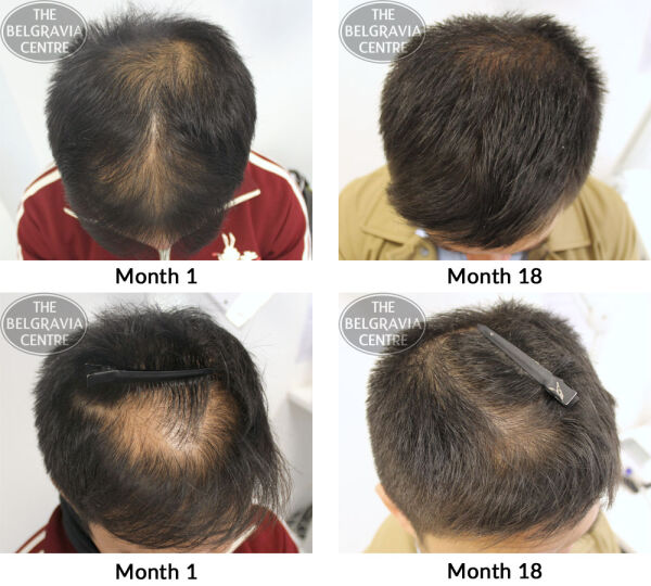 male pattern hair loss the belgravia centre md 13 10 2017