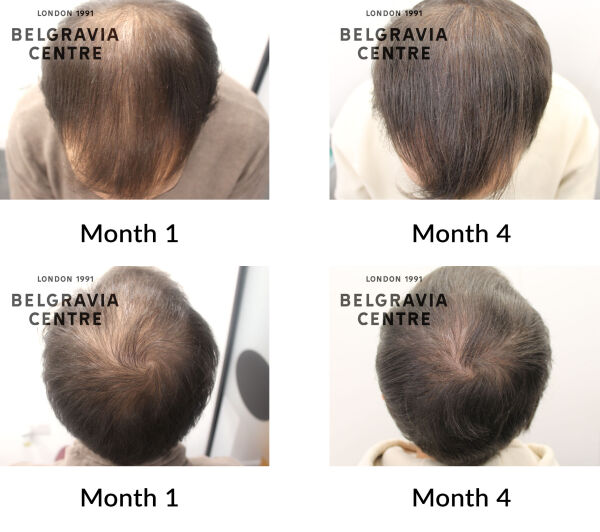 male pattern hair loss the belgravia centre 449425