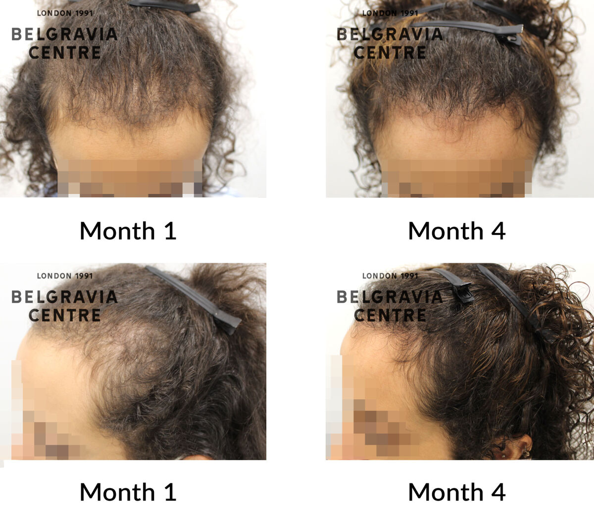 female pattern hair loss the belgravia centre 434016