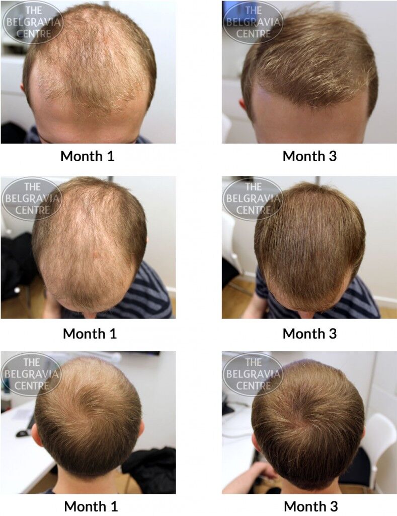 Male Pattern Hair Loss The Belgravia Centre JS 17 06 789x1024