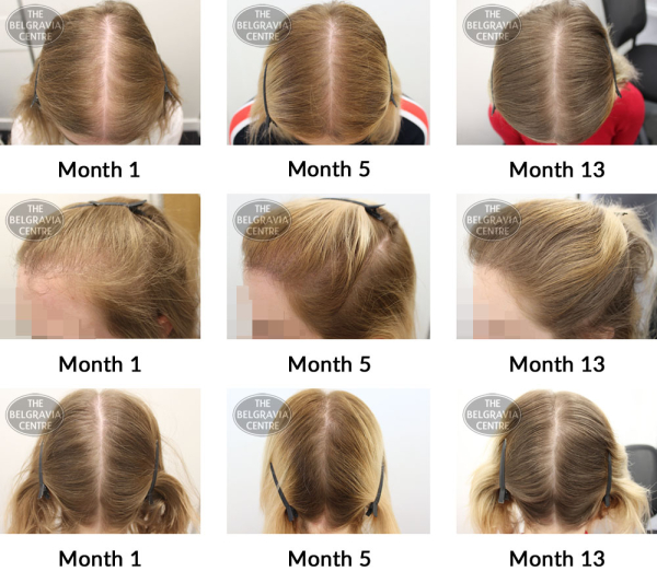 female pattern hair loss the belgravia centre 353315 29 03 2019