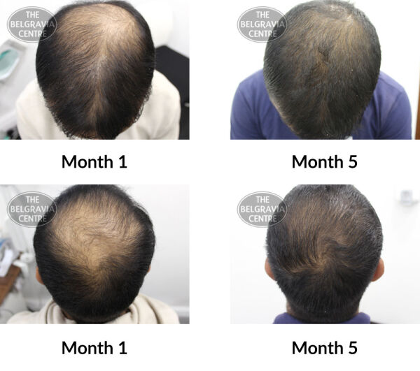 male pattern hair loss the belgravia centre 397344 08 07 2020