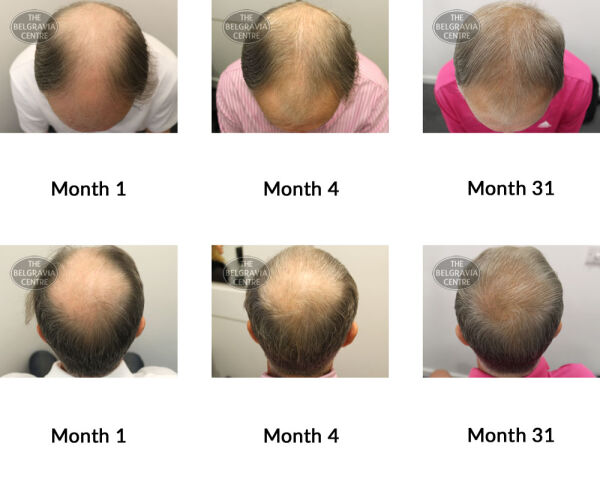 male pattern hair loss the belgravia centre 306839 30 07 2019