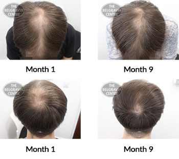 alert male pattern hair loss the belgravia centre 404966 10 05 2021