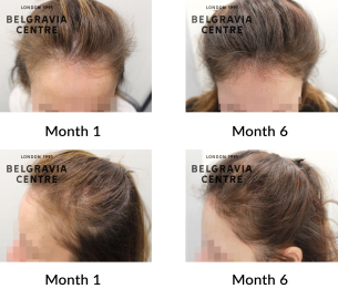 telogen effluvium and female pattern hair loss the belgravia centre 447328