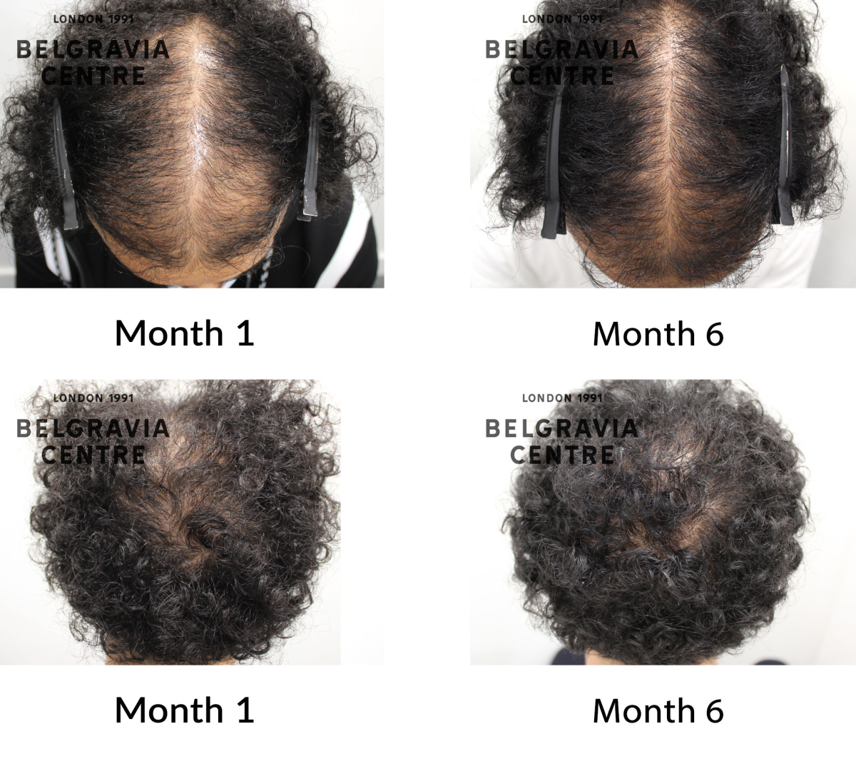 male pattern hair loss the belgravia centre 409887